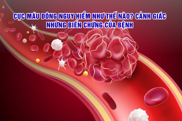 Cục máu đông nguy hiểm như thế nào? Cảnh giác những biến chứng của bệnh