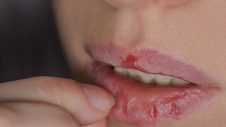 Môi khô nẻ suốt 6 tháng, rỉ máu không dứt, bác sĩ chỉ ra thủ phạm 