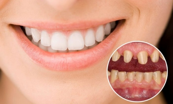 Bi hài hậu vận thẩm mỹ: Khổ sở vì miệng hôi, răng không nhai được vì bọc răng sứ, người phụ nữ cầu cứu bác sĩ