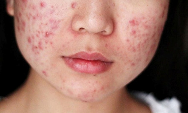 Nóng gan là dấu hiệu cảnh báo các vấn đề sức khoẻ, đừng chủ quan!
