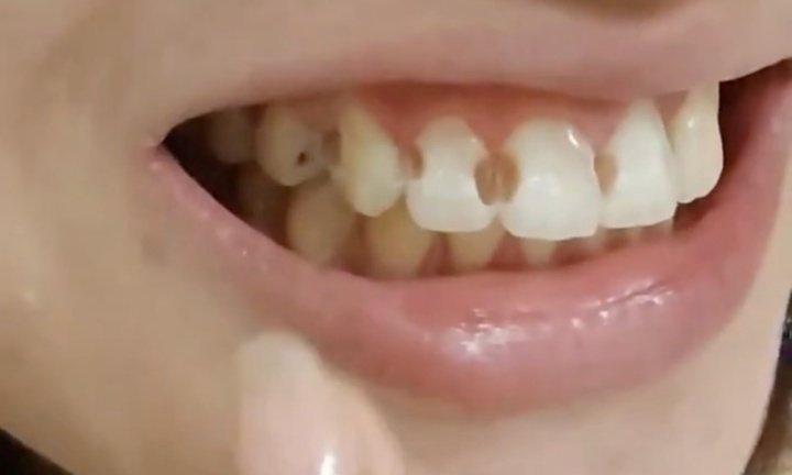 Niềng răng 5 năm, cô gái 20 tuổi nhận cú sốc lớn khi phát hiện 8 chiếc răng bị thủng lỗ