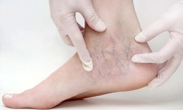 Thay đổi ở bàn chân, cảnh báo gan đang gặp vấn đề 