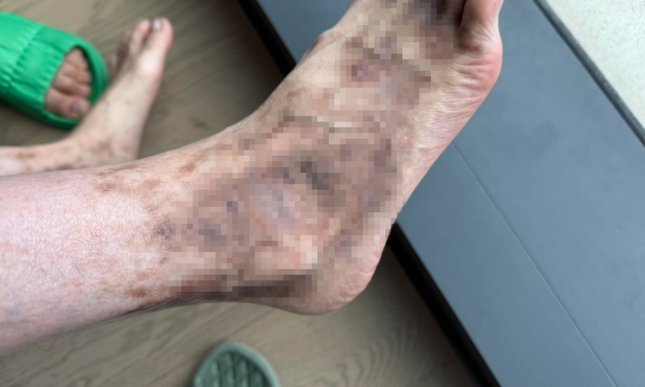 Viêm mao mạch hoại tử: Biến chứng nguy hiểm, có thể gây tổn thương vĩnh viễn