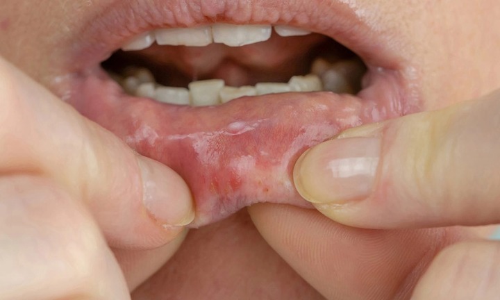 Nếu miệng có những dấu hiệu này chứng tỏ gan đang cầu cứu, đi khám ngay!