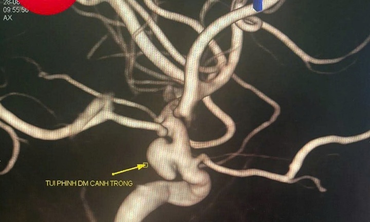 Tin tức đời sống 2/9: Từ triệu chứng đau đầu, run tay, vô tình phát hiện 