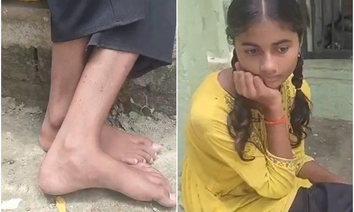 Clip: Kỳ lạ bé gái bị rắn cắn 9 lần trong vòng 40 ngày 