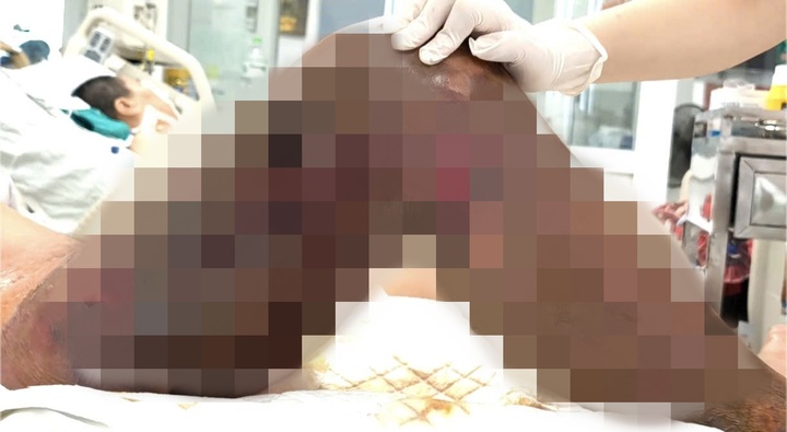 Người đàn ông hoại tử vùng loang lổ vì một vết xước nhỏ, suýt cướp đi mạng sống