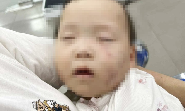 Xác minh vụ bé gái ở Bắc Ninh bị bầm tím mặt khi gửi ở nhà trẻ tư thục