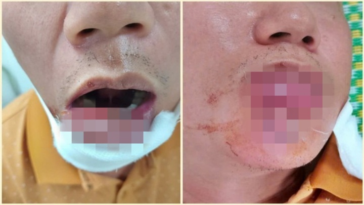 Mắc sai lầm phổ biến khi nặn mụn, người đàn ông nhập viện với đôi môi biến dạng