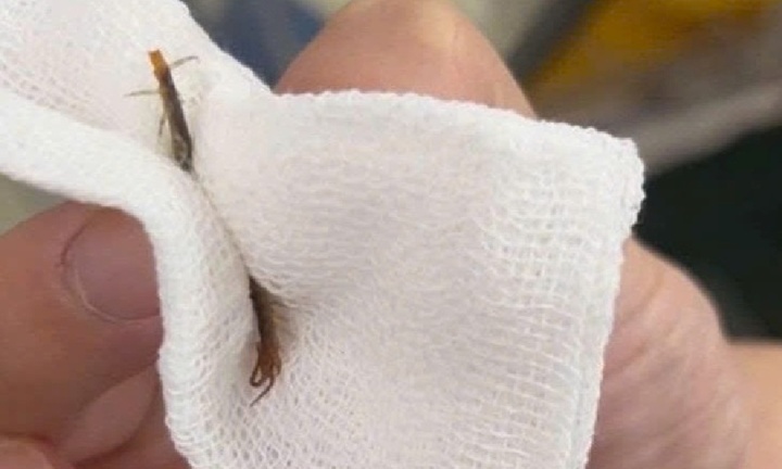 Nam bệnh nhân nhập viện vì con rết dài 5cm chui vào tai khi đang ngủ