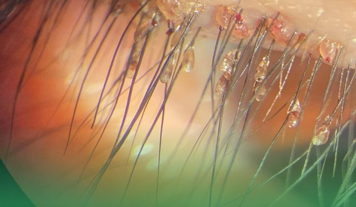 Phát hiện sinh vật đáng sợ bên dưới mi mắt của cụ bà 68 tuổi ở Hà Nội