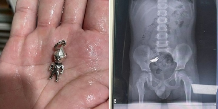 Chụp X-quang bụng bé trai 7 tuổi, bác sĩ sửng sốt khi phát hiện dị vật bất ngờ