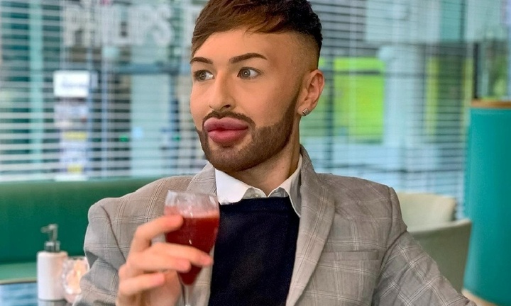 Chi 124 triệu đồng cho filler, chàng trai 25 tuổi vỡ mộng chịu đau đớn để lấy lại vẻ ngoài tự nhiên