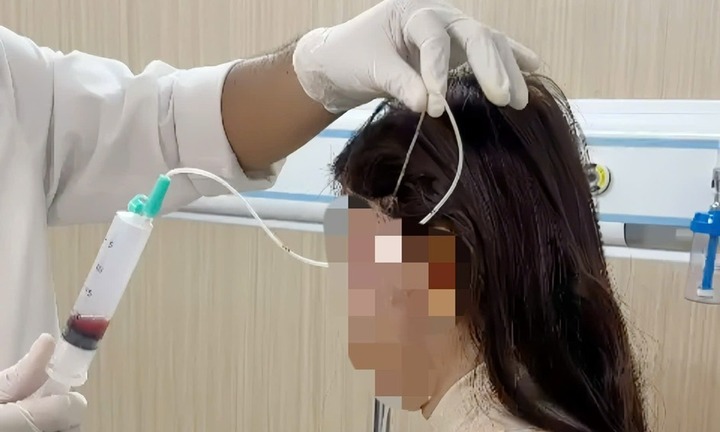 Tin tức đời sống 24/9: Người phụ nữ bị hoại tử mặt nặng sau 1 năm tiêm filler