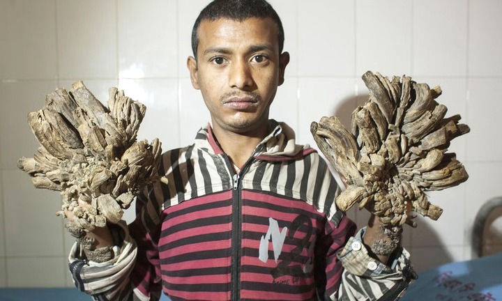 Người đàn ông có làn da như vỏ cây vì mắc hội chứng lạ