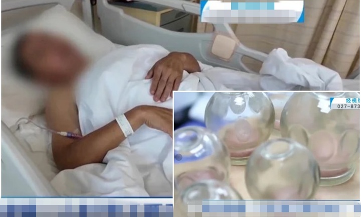Nhờ cháu gái giác hơi tại nhà, người đàn ông ở Trung Quốc tổn thương tủy sống, liệt nửa người