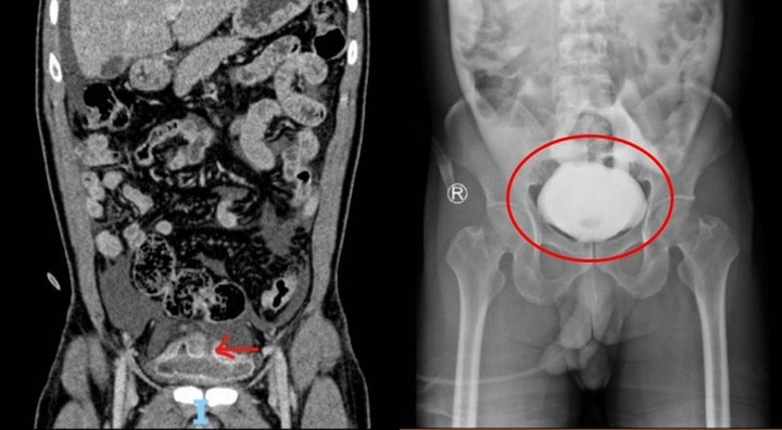 Nhịn tiểu lâu lúc uống bia, người đàn ông vỡ bàng quang sau khi té ngã