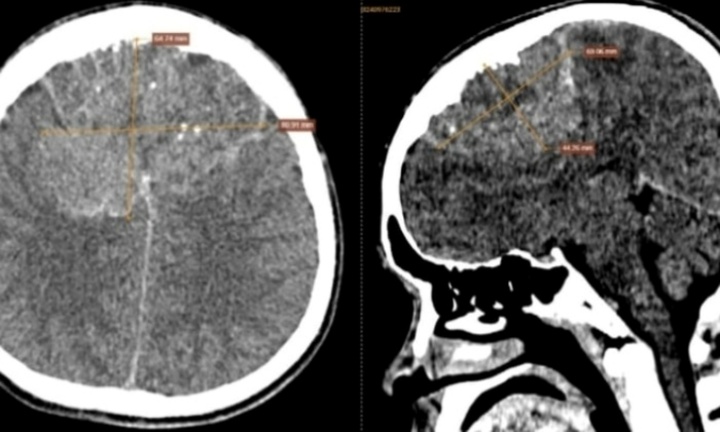 Tin tức đời sống 3/10:  Đau đầu dai dẳng, nam sinh nhập viện mới biết bị ung thư