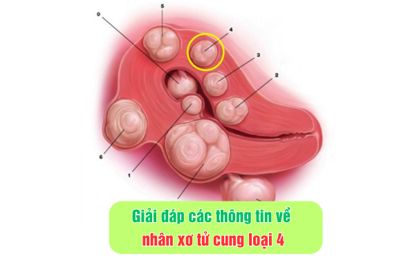 Giải đáp các thông tin về nhân xơ tử cung loại 4
