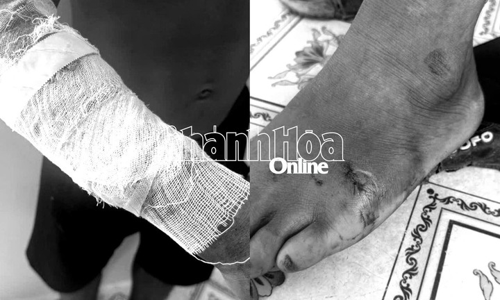 Cá sấu nặng 10kg sổng chuồng, nam thanh niên ở Khánh Hòa bị tấn công đến thương tích 