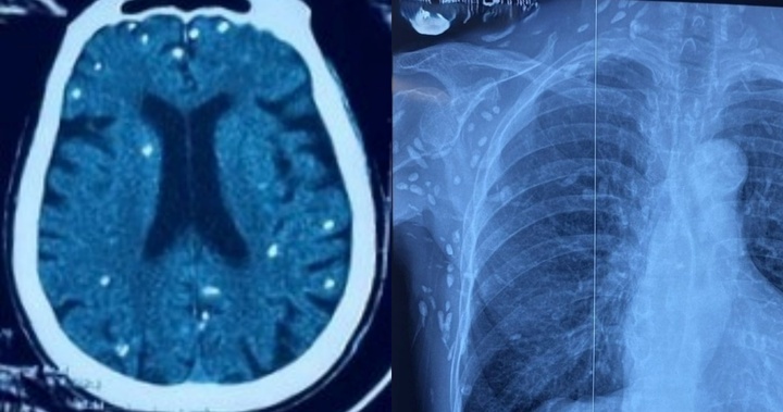 Phát hiện chi chít nhiều nốt sán dây lợn ở não và cơ thể  cụ bà 76 tuổi