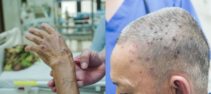 Tin tức đời sống 12/10: Bị ong vò vẽ đốt hơn trăm nốt, người đàn ông suýt chết vì sốc phản vệ