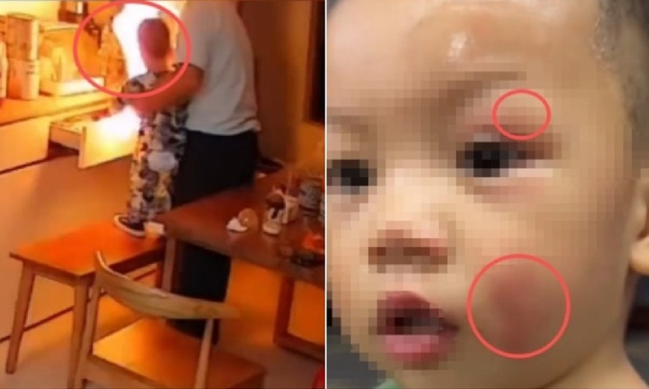 Cháu bé bị cháy tóc, bỏng mặt vì ông nội 