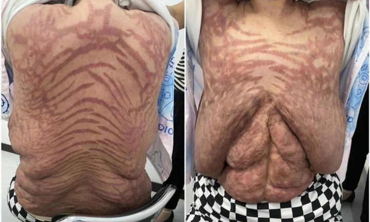 Người phụ nữ da nổi vết rạn như da rắn vì bôi thuốc trị ngứa mua trên mạng