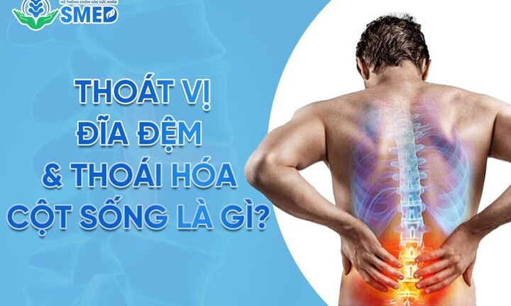 Thoái hóa cột sống & thoát vị đĩa đệm – Lý do khiến hàng triệu người Việt mắc phải