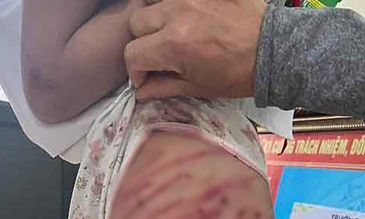 Vụ bé gái lớp 5 thương tích khắp người, nghi bị bố dượng đánh: Người mẹ đang ở đâu?