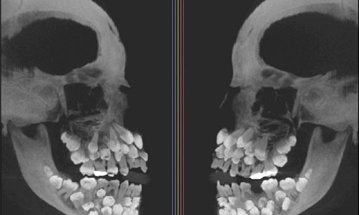 Bé gái 11 tuổi có tới 81 chiếc răng, bác sĩ lý giải về hiện tượng y học hiếm gặp