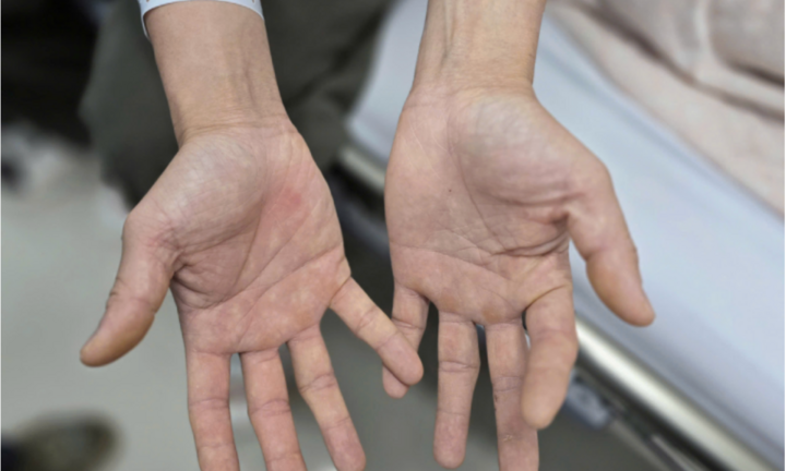 Tin tức đời sống 29/10: Hai vợ chồng nhập viện sau thời gian dài hít bóng cười