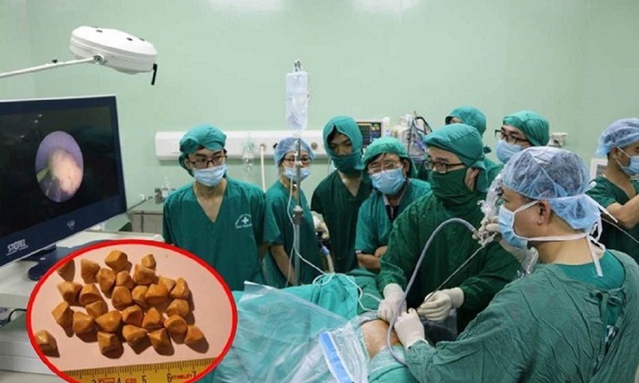 Người bị cắt túi mật nên làm gì để mau hồi phục và tránh tái phát?