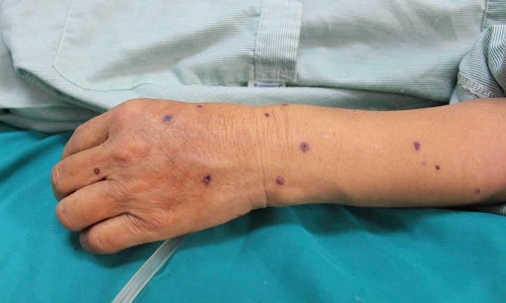 Người phụ nữ bị ong vò vẽ tấn công với hơn 80 vết đốt, nguy kịch