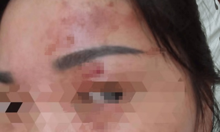 Người phụ nữ bỏng giác mạc vì bất cẩn khi giặt đồ