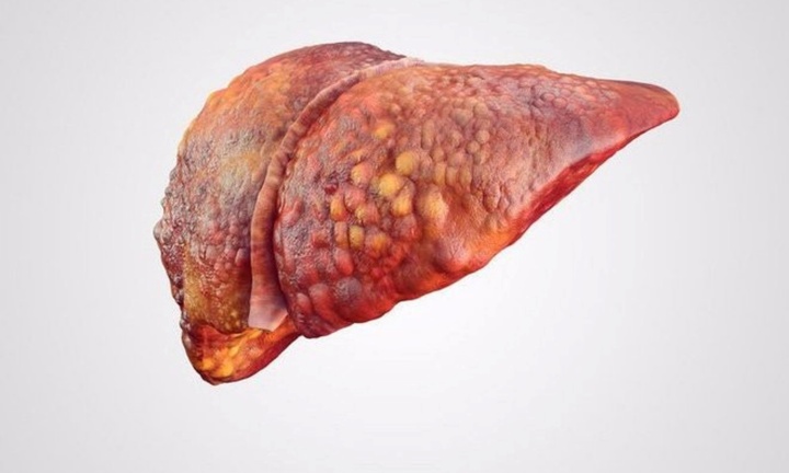 Dấu hiệu cảnh báo gan đang 