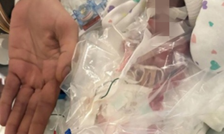 Chào đời sớm 3 tháng, bé gái chỉ nặng bằng 