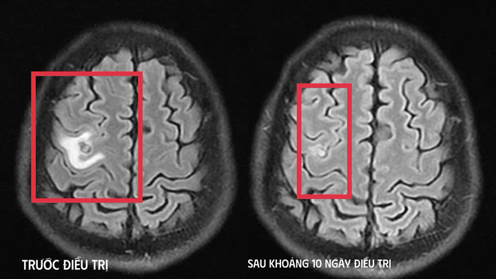 Người đàn ông co giật cứ ngỡ do u não, đi khám mới biết có sán làm tổ