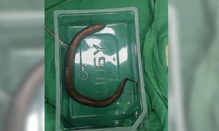 Con lươn dài 30 cm được phát hiện còn sống bơi trong ổ bụng chàng trai