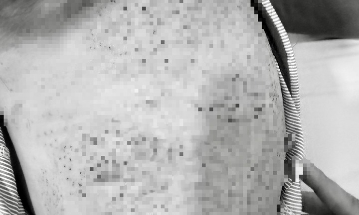 Tin tức đời sống 3/12: Người phụ nữ nhập viện cấp cứu sau khi chích lể, giác hơi