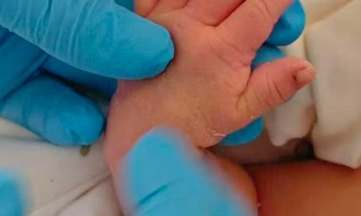 Nữ hộ sinh cắt nhầm vào tay bé sơ sinh khi xử lý dây rốn