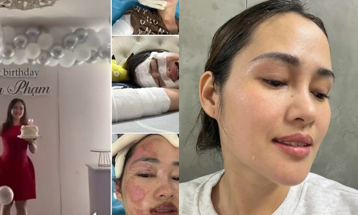 Khó tin diện mạo của cô gái từng bị bỏng nặng do bóng bay sinh nhật phát nổ 