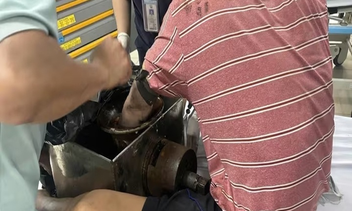 Hi hữu: Người đàn ông ở TP.HCM vác cả máy xay thịt đến bệnh viện cấp cứu