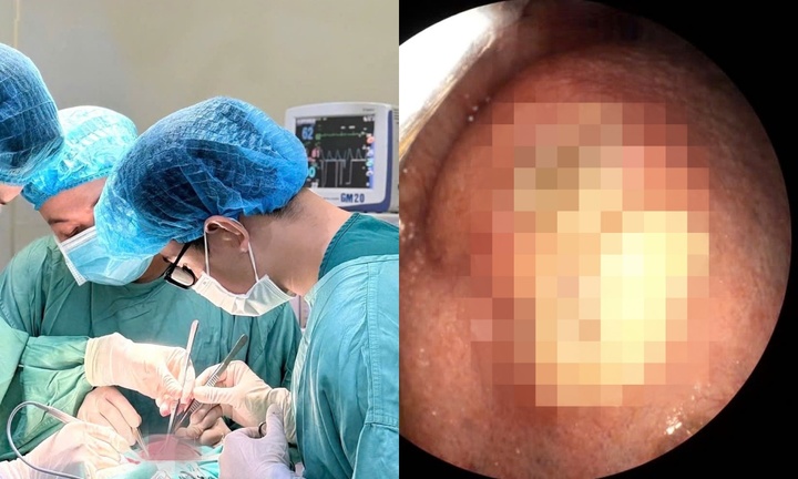 Vết loét nhỏ 0,5cm tồn tại 1 năm tưởng lành tính lại hóa ung thư di căn