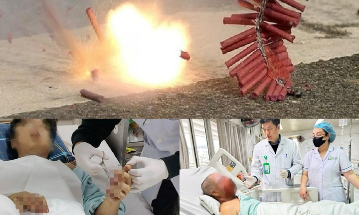 Cảnh báo nguy cơ tai nạn pháo nổ: Nhiều ca nguy kịch, di chứng nặng nề