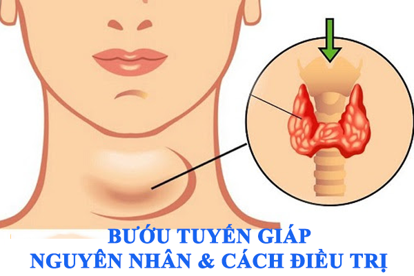 Bướu tuyến giáp: Nguyên nhân, triệu chứng và cách kiểm soát hiệu quả