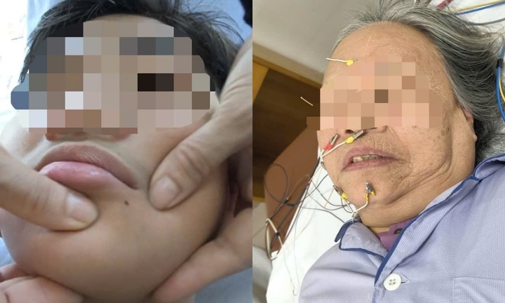 Chỉ vì cởi áo giữa trời rét, bé trai 11 tuổi ở Hà Nội đột ngột méo miệng