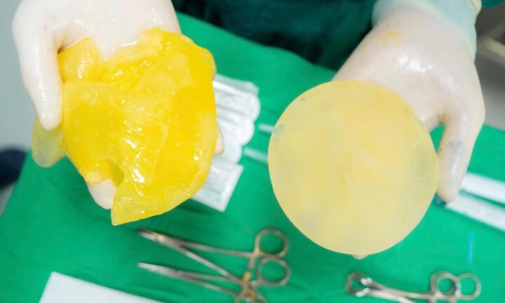 Chơi pickleball vỡ túi ngực, chuyên gia chỉ cách chơi an toàn