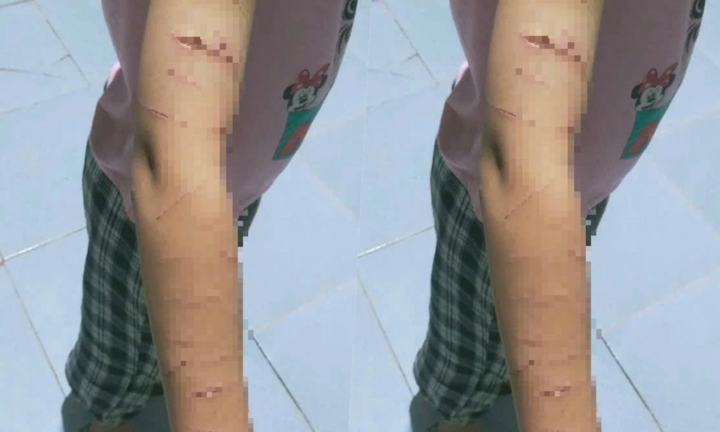 Xác minh vụ nữ sinh lớp 5 bị người thân dùng dao cắt giấy gây thương tích