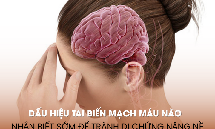 Dấu hiệu tai biến mạch máu não: Nhận biết sớm để tránh di chứng nặng nề